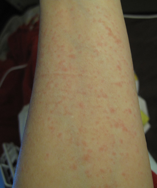 rash